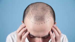 Experience the Confidence of a Natural Look with Hair Transplant