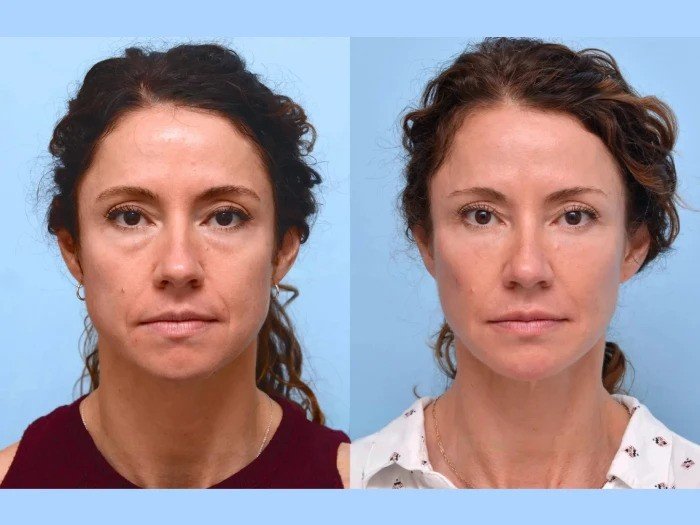 Best Plastic Surgeons in Dubai Delivering Beautiful Thread Lift Results Without Surgery