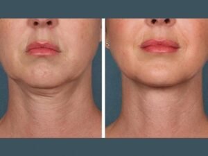 Best Aesthetic Clinics in dubai for PRP Injections for Radiant Complexion