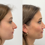 How Preservation Rhinoplasty in Dubai Maintains Nasal Structure and Function