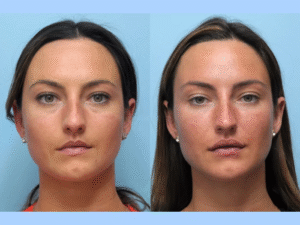 Achieve a Natural Lift with the Best Aesthetic Clinics in Dubai for Thread Lift