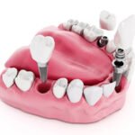 How Dental Implants in Islamabad Help Prevent Tooth Movement