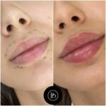 Are Juvederm Fillers Right for You? Find Out at the Best Aesthetic Clinics in Dubai