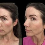 Natural and Non-Surgical Dark Circles Treatment by the Best Doctors in Dubai