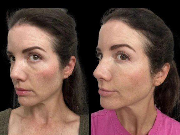 Why People Trust the Best Aesthetic Clinics in Dubai for Long-Lasting Dark Circles Results