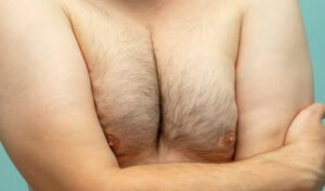What Causes Gynecomastia in Men?