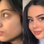 Discover the Precision Behind Modern Rhinoplasty in Dubai