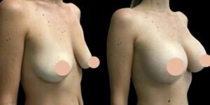 The Role of Pre-Surgery Consultation in Breast Augmentation Surgery in Dubai