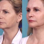 Best Anti-Aging Results from Chemical Peel Treatments in Dubai