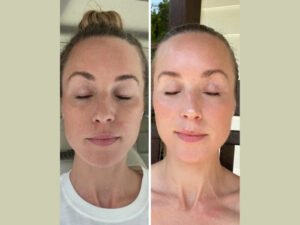 Your Complete Skincare Solution with Fotona 4D Laser in Dubai