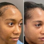 Best Doctors in Dubai Share Their Secrets: Chemical Peel for Radiant Complexion