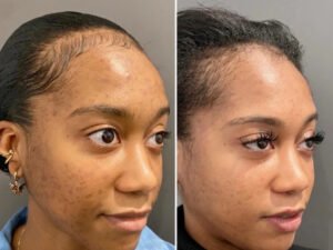 Best Doctors in Dubai Share Their Secrets: Chemical Peel for Radiant Complexion