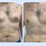 Why the Best Doctors in Dubai Recommend Early Treatment for Gynecomastia