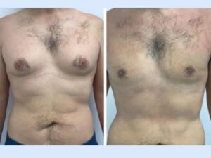 Why the Best Doctors in Dubai Recommend Early Treatment for Gynecomastia