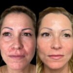 Awakens with Profhilo Treatment in Dubai