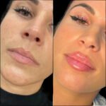 The Luxury Aesthetic Experience: Fillers in Dubai