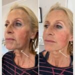 Best Doctors in Dubai for Safe and Effective Endolift Treatments