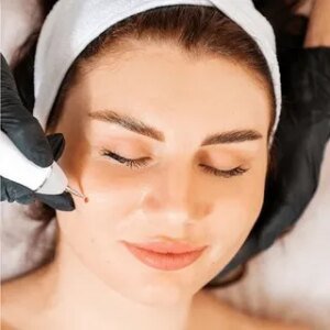 Guide to Laser Mole Removal in Islamabad