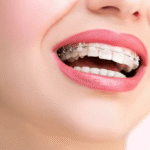 Braces That Fit Your Lifestyle