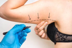 Liposuction in Riyadh: How It Fits Into Your Overall Fitness Plan