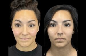 How the Best Plastic Surgeons in Dubai Achieve a Youthful Look with Botox