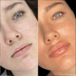 Get Natural Results from the Best Doctors in Dubai for Fillers