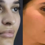 Functional Rhinoplasty in Dubai: Improve Breathing & Shape