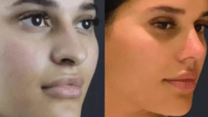 Functional Rhinoplasty in Dubai: Improve Breathing & Shape