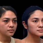 Preventing Dark Circles Naturally Alongside Dark Circles Treatment in Dubai