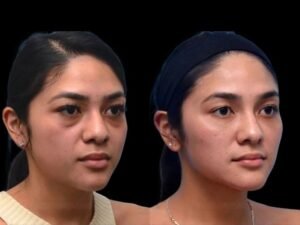 Preventing Dark Circles Naturally Alongside Dark Circles Treatment in Dubai