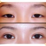 Best Cosmetic Eye Surgeon in Islamabad – Natural Looking Results