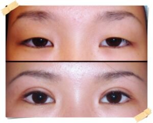 Best Cosmetic Eye Surgeon in Islamabad – Natural Looking Results