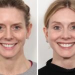 Thread Lift Treatment in Dubai for Upper Neck Lift