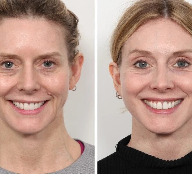 Thread Lift Treatment in Dubai for Upper Neck Lift