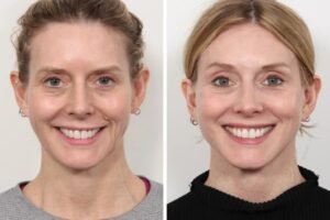 The Art of Non-Surgical Lifting With Thread Lift Treatment in Dubai