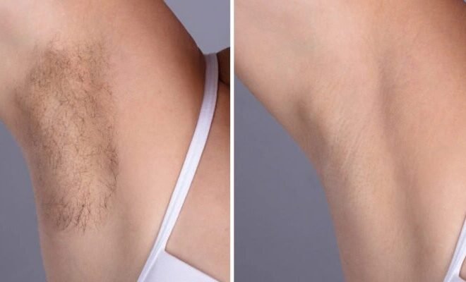 Laser hair removal Treatments in Dubai: How Works for Different Skin Types