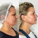 Endolift Treatment in Dubai: Endolift Treatment in Dubai for Cheeks and Midface Lift