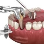 Best Dental Bleaching Treatment in Pune