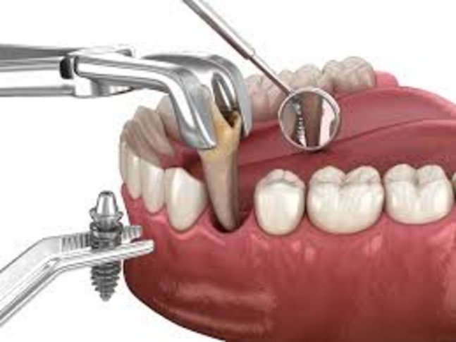 Best Dental Bleaching Treatment in Pune