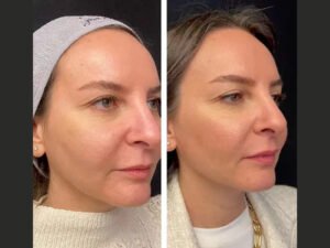 Mesotherapy in Dubai – Hydration Boost for Dry Skin