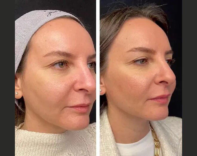 Mesotherapy in Dubai – Hydration Boost for Dry Skin