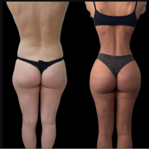 Experience Advance J-Plasma Technology at the Best Aesthetic Clinic in Dubai