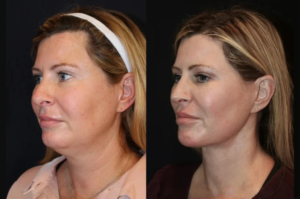 How the Best Aesthetic Clinic in Dubai is Transforming Skin Tightening in Dubai Procedure