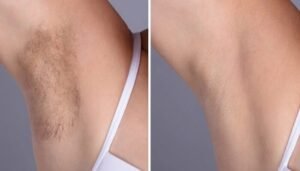Laser hair removal Treatment in Dubai: How to Achieve Permanent Hair Reduction Safely