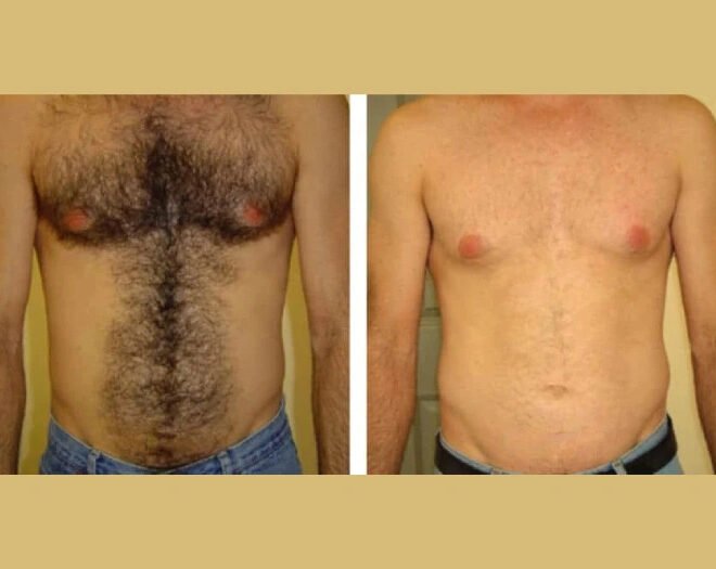 Best Aesthetic Clinics in Dubai for Dark and Light Skin Electrolysis Laser Hair Removal in Dubai