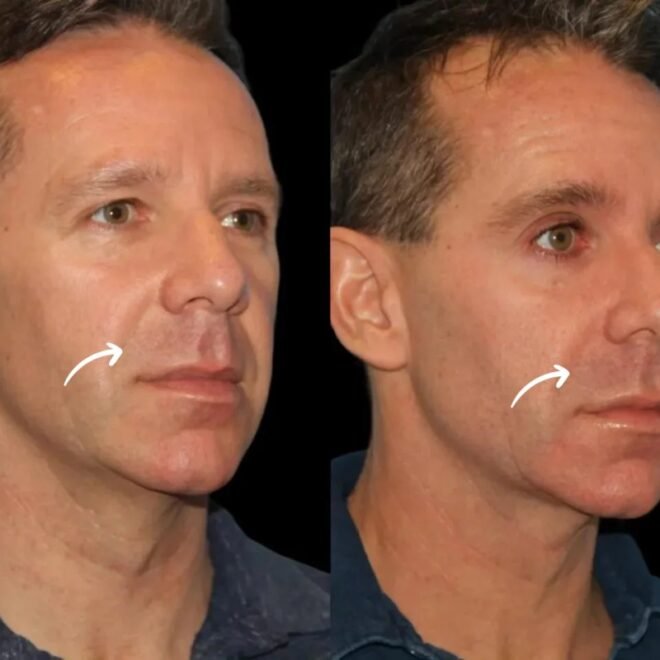 Dilution Protocols for Sculptra at Best Aesthetic Clinic in Dubai