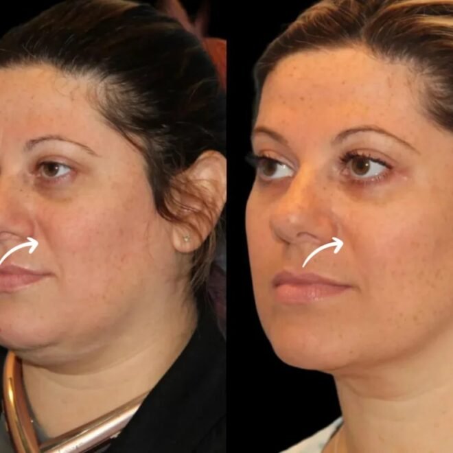 Sculptra Dilution Guidelines at Best Aesthetic Clinic in Dubai