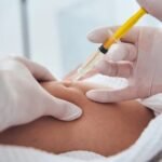 Lemon Bottle Injection: Non-Invasive Fat Reduction