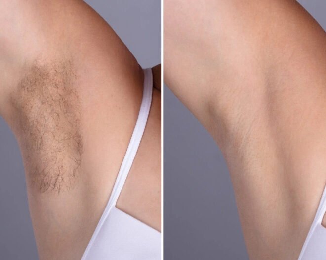 Best Doctors in Dubai Laser Hair Removal for Sensitive Skin Areas