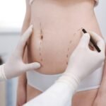 How to Pick the Best Liposuction Surgeons in Dubai for Your Needs